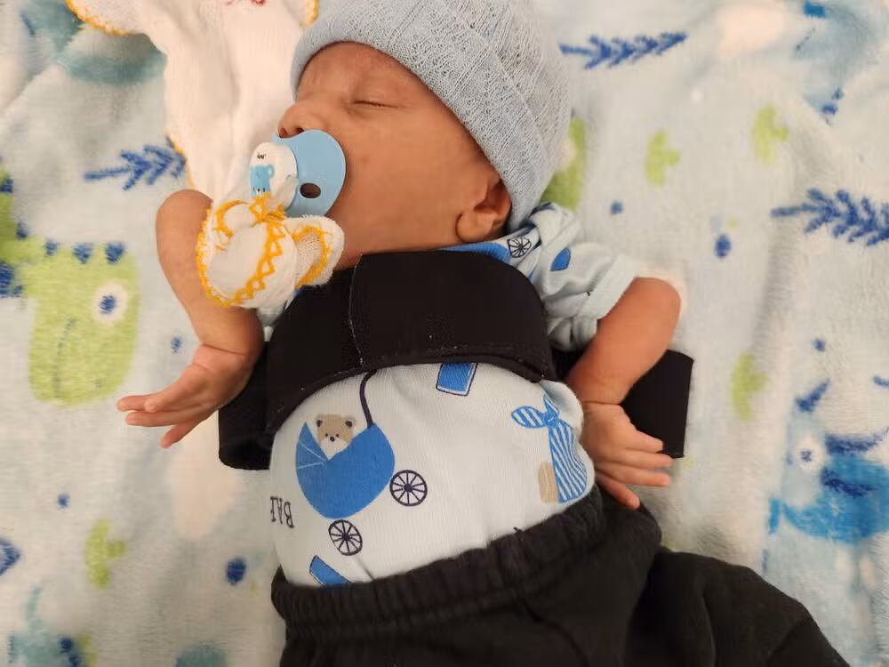 La artrogriposis es una enfermedad congénita rara que causa rigidez en las articulaciones y limita el movimiento desde el nacimiento.