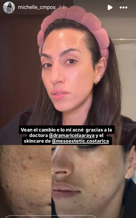 Michelle Campos mostró en sus redes sociales cómo ha cambiado su rostro.