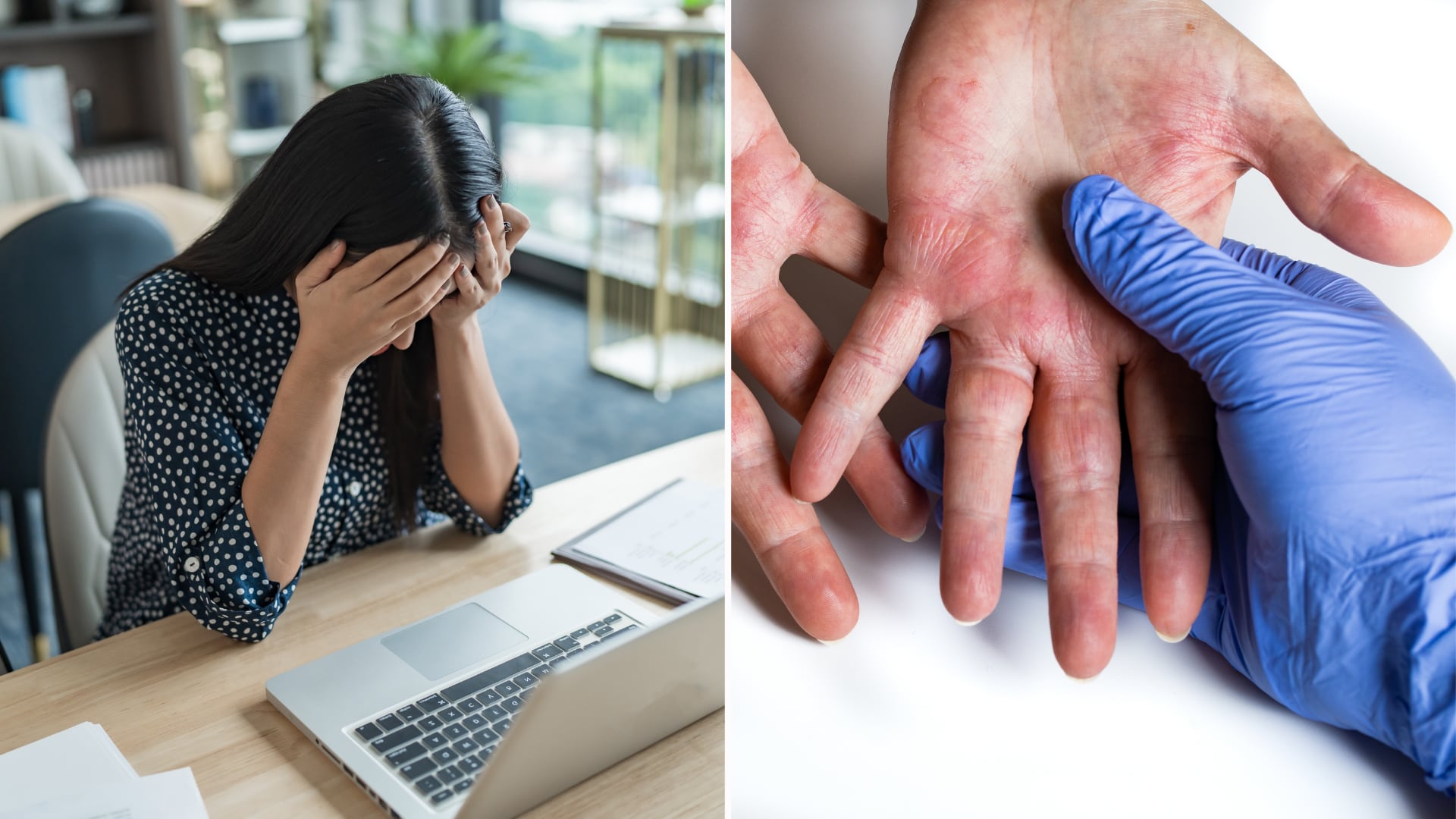 La investigación halló cómo el estrés activa un circuito que empeora los brotes de dermatitis atópica.