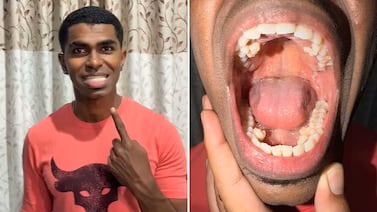 ¿Es posible tener más de 32 dientes? Este hombre tiene 42 y logró un récord mundial