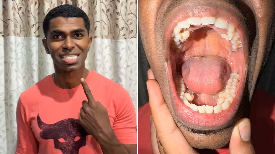 Un malayo logró un récord Guinness al registrar 42 dientes en su boca. La cifra supera por diez el promedio humano y se relaciona con hiperdontia.