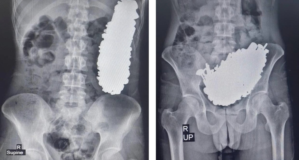 En Irán, un hombre con psicosis ingirió 452 objetos metálicos, lo que causó una obstrucción gástrica y requirió cirugía.