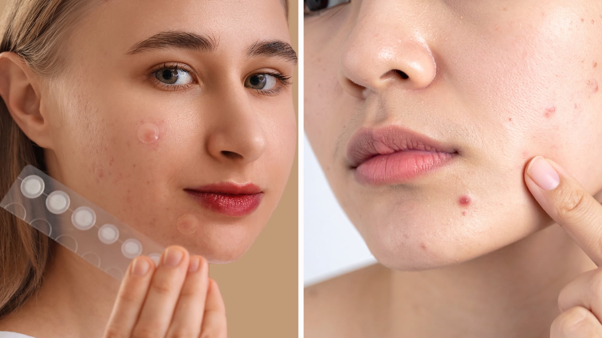 Los parches de acné pueden acelerar la desaparición de algunos granos, pero existen situaciones y tipos de piel en los que su uso no se recomienda.