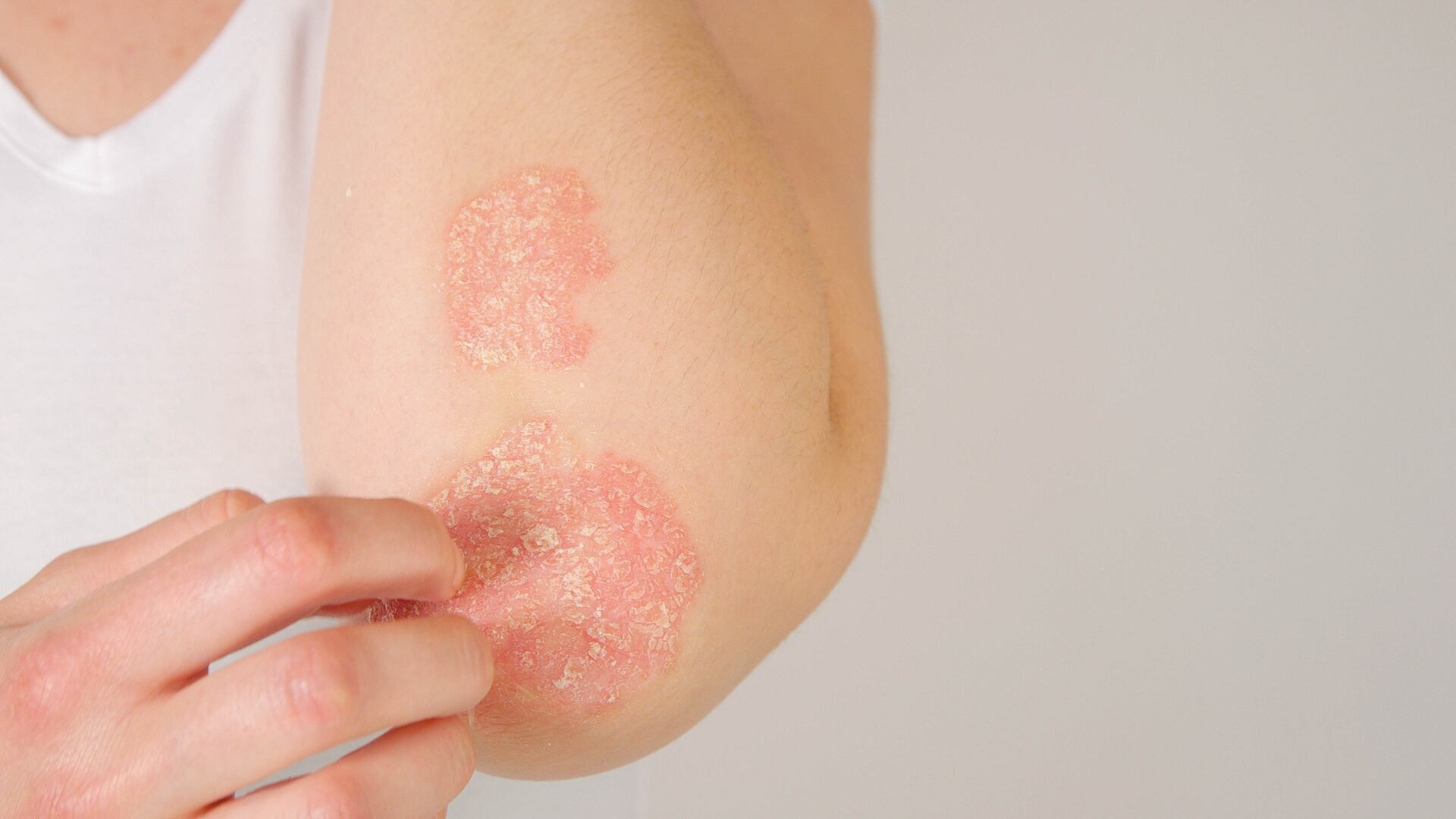 La forma más rápida de detectar la psoriasis es por las placas con escamas en la piel. Si nota algo similar, acuda a un médico para recibir el diagnóstico correcto.