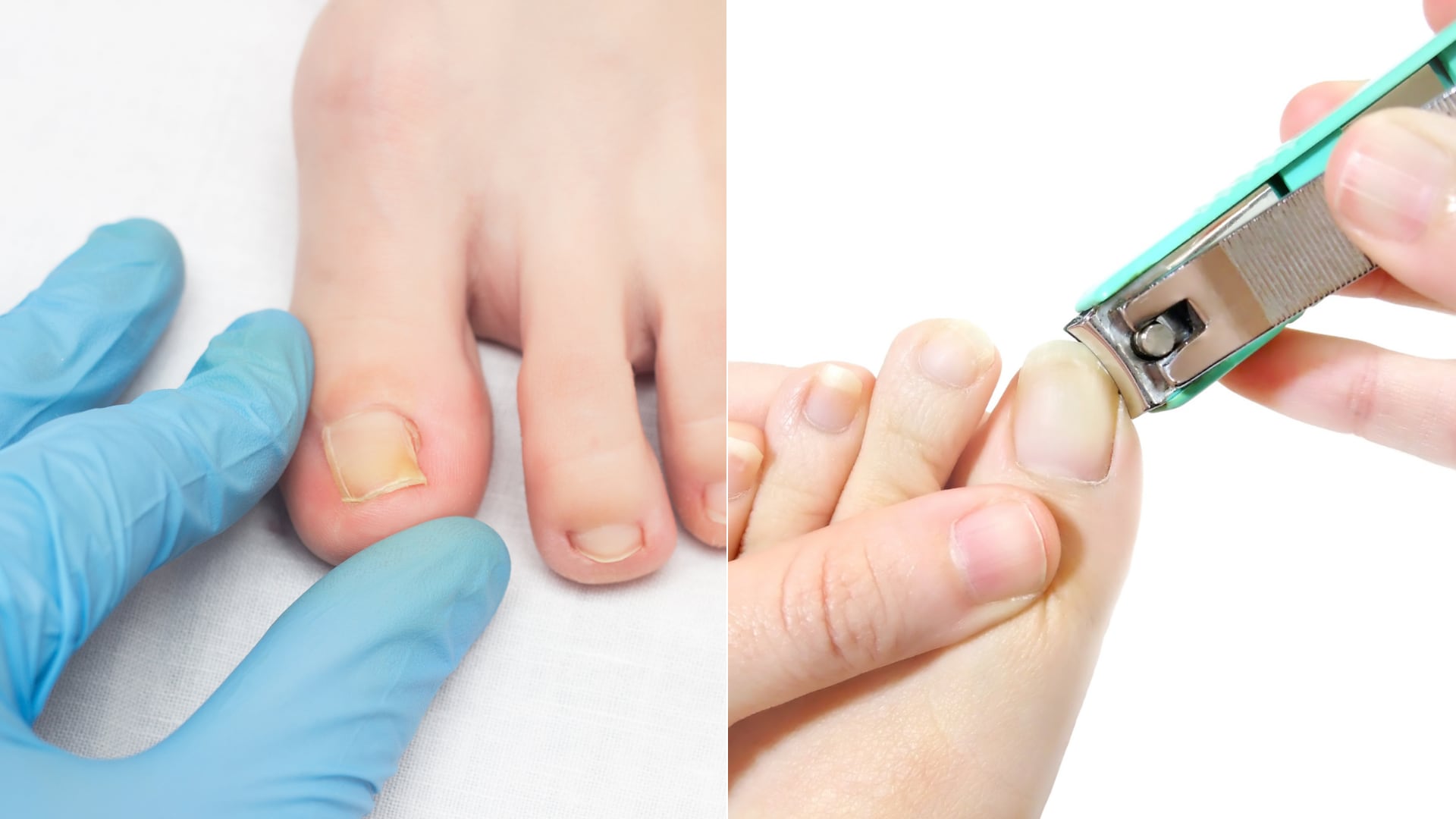 Especialistas en podología demuestran que las infiltraciones directas reducen la inflamación en 1,9 mm y mejoran la movilidad en pacientes afectados.