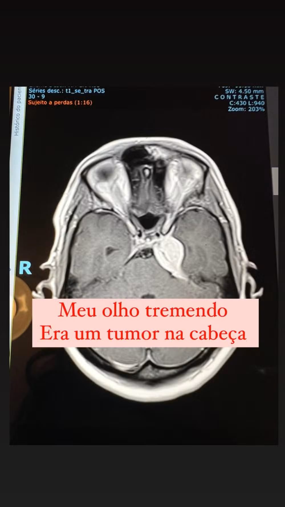 Tomografía computarizada con contraste, en la que la parte blanca muestra el tumor en la cabeza de Luiza.