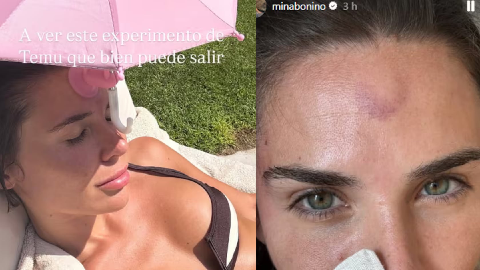 La periodista mostró en redes una mini sombrilla comprada en Temu que terminó dejándole un moretón.