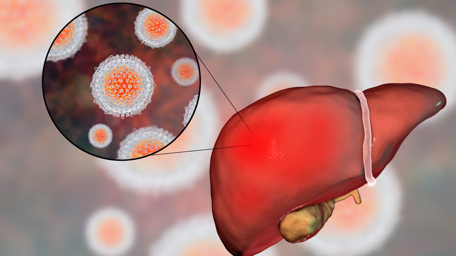 Los virus de la hepatitis pueden provocar una respuesta inflamatoria que termina dañando las células del hígado.