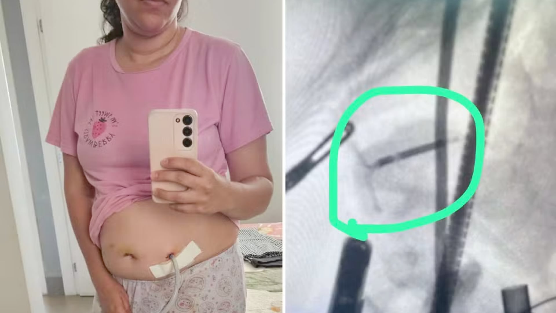 Colocó un DIU, quedó embarazada y pensó que lo había perdido. Tres años después lo hallaron dentro del intestino y necesitó una cirugía compleja.