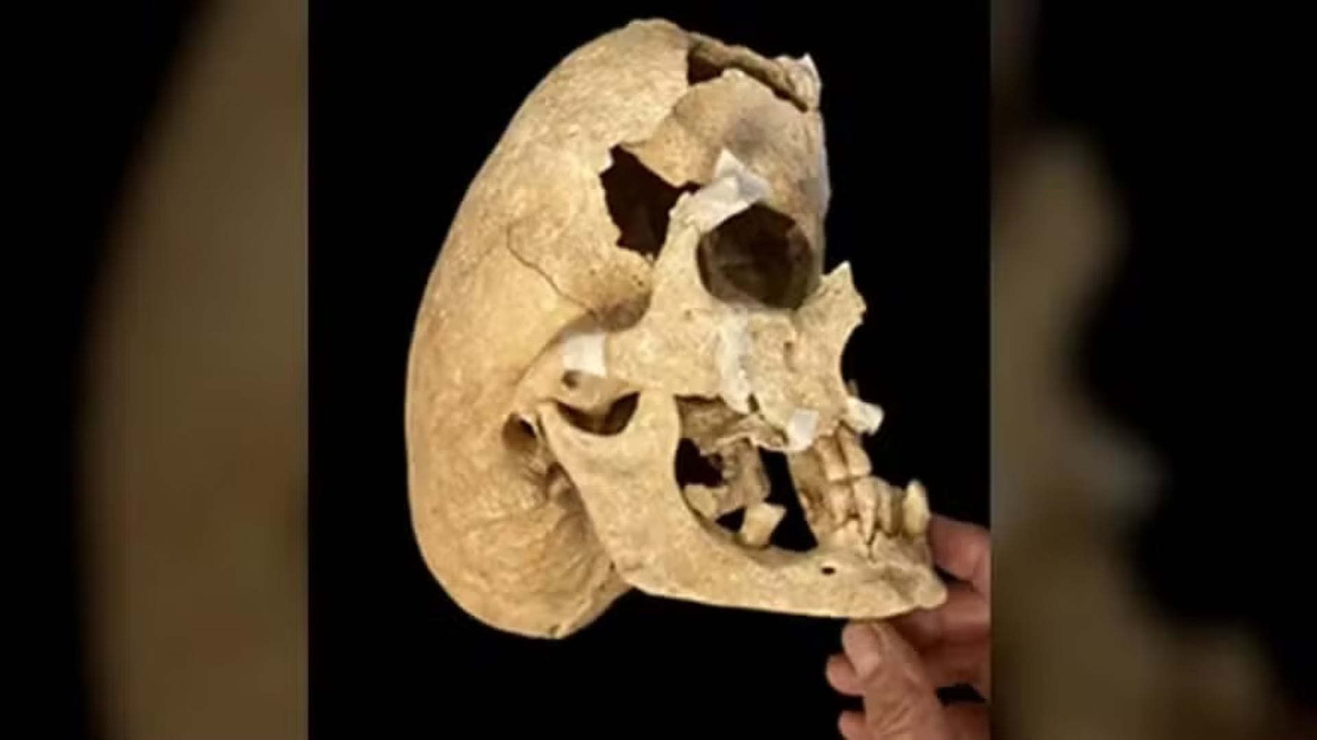 Un estudio reveló que un caballero medieval hallado en España tenía una extraña malformación craneal causada por craniosinostosis.
