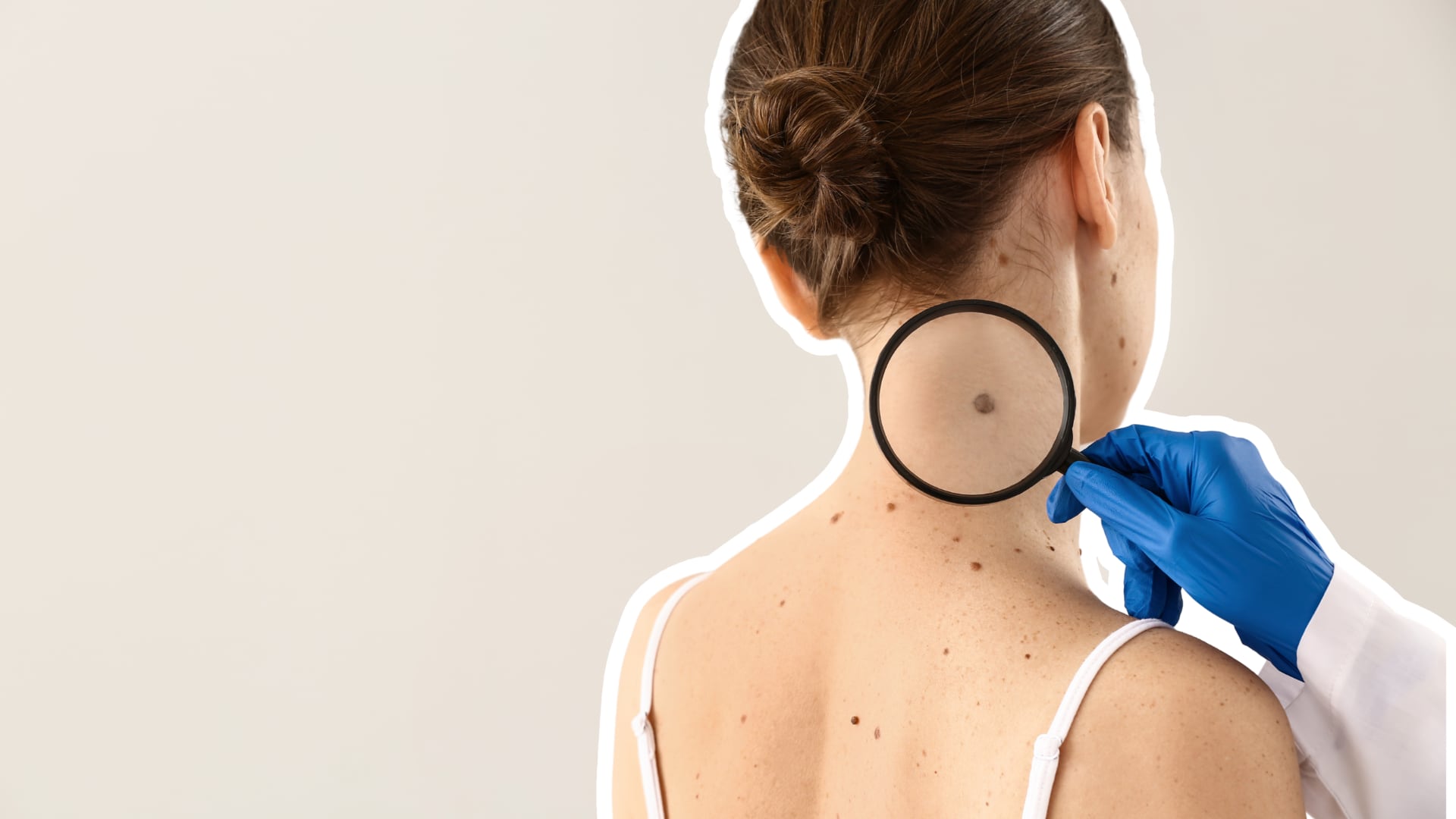 Cáncer de piel: cómo revisar los lunares y detectar señales de alerta a tiempo