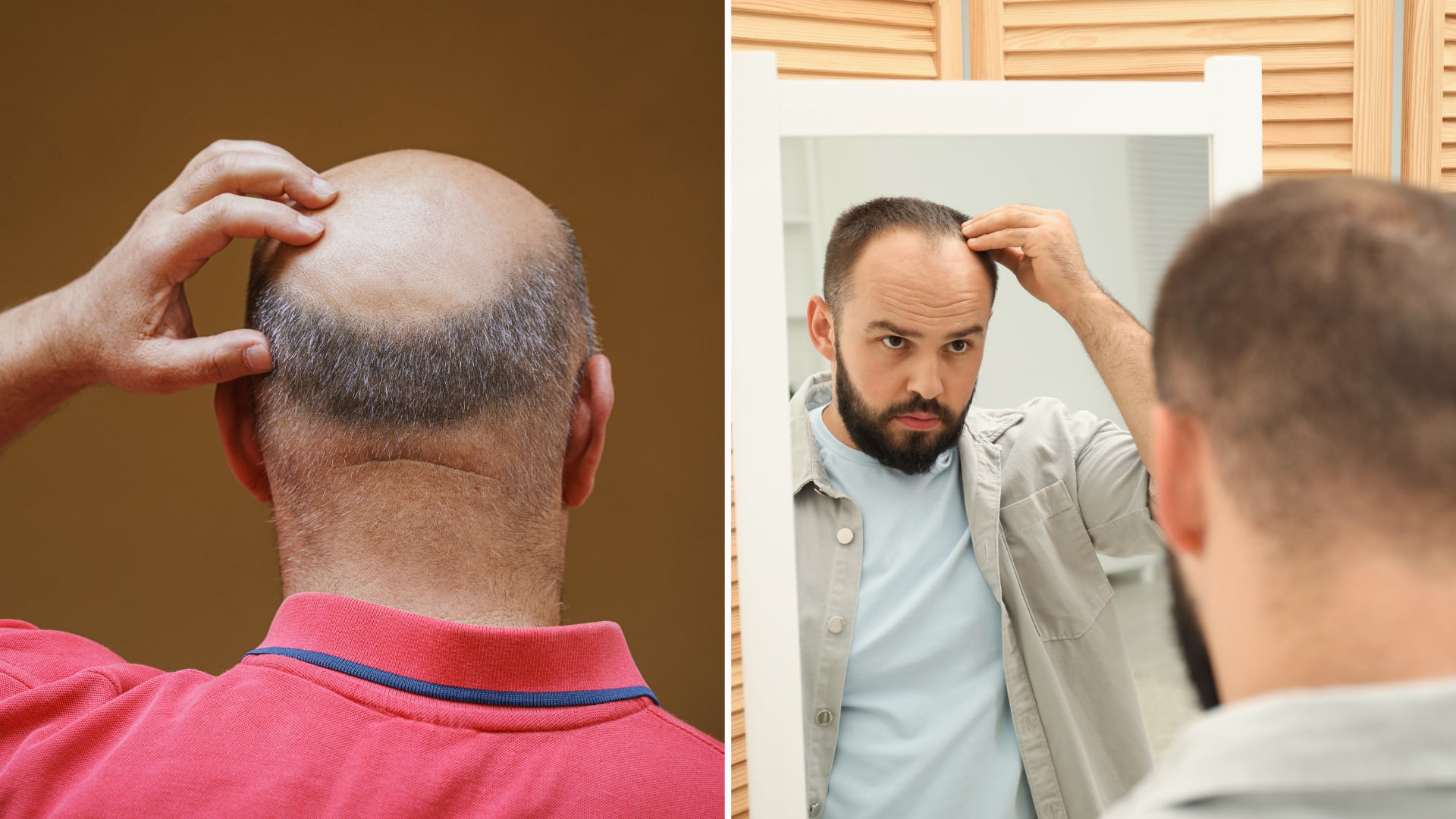 Análisis de 15.836 genomas evidenció que la selección natural redujo genes ligados a la calvicie masculina y reforzó otros rasgos en Eurasia.