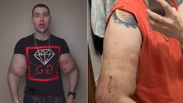 Así luce ahora el ‘Popeye ruso’ tras retirar el aceite de sus bíceps: médico advirtió posible amputación