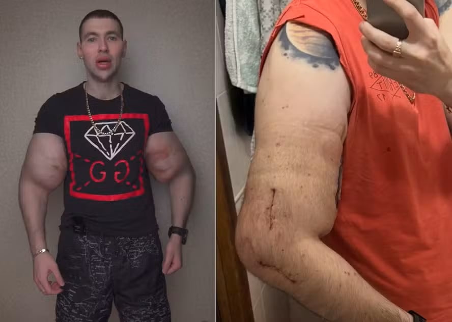 El “Popeye ruso” documentó en redes sociales la transformación de su brazo tras el retiro del aceite que ponía en riesgo su salud.