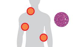 ¿Sabe qué es un linfoma y cómo evitar padecerlo?